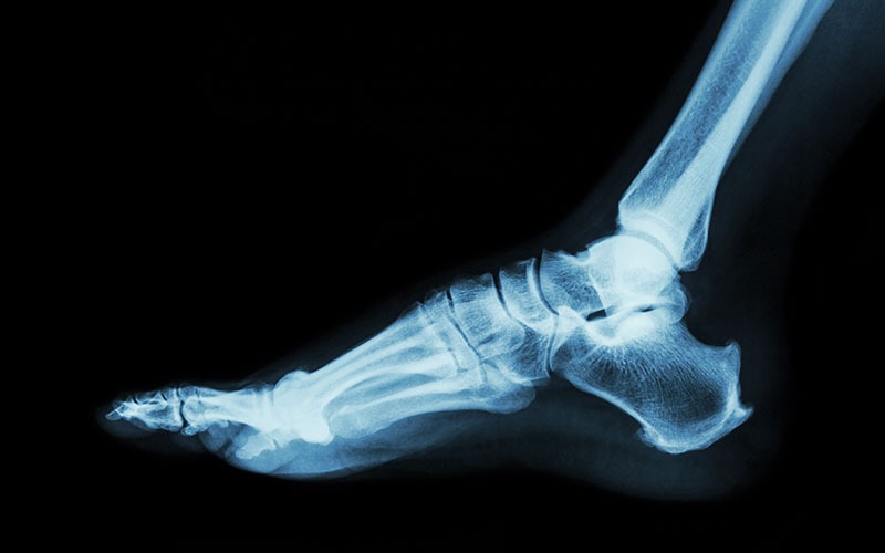 Xray of ankle. Image is clickable to download the ANKLE/ACHILLES Post-Operative Instructions